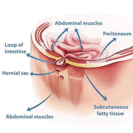 Hernia