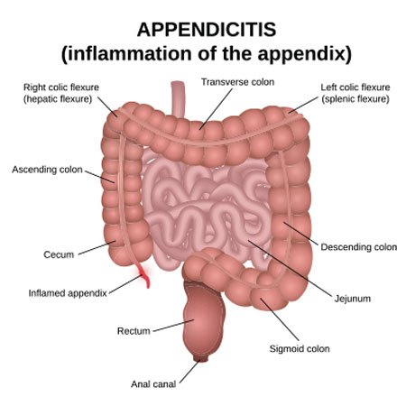 Appendicitis (Appendix Removal)
